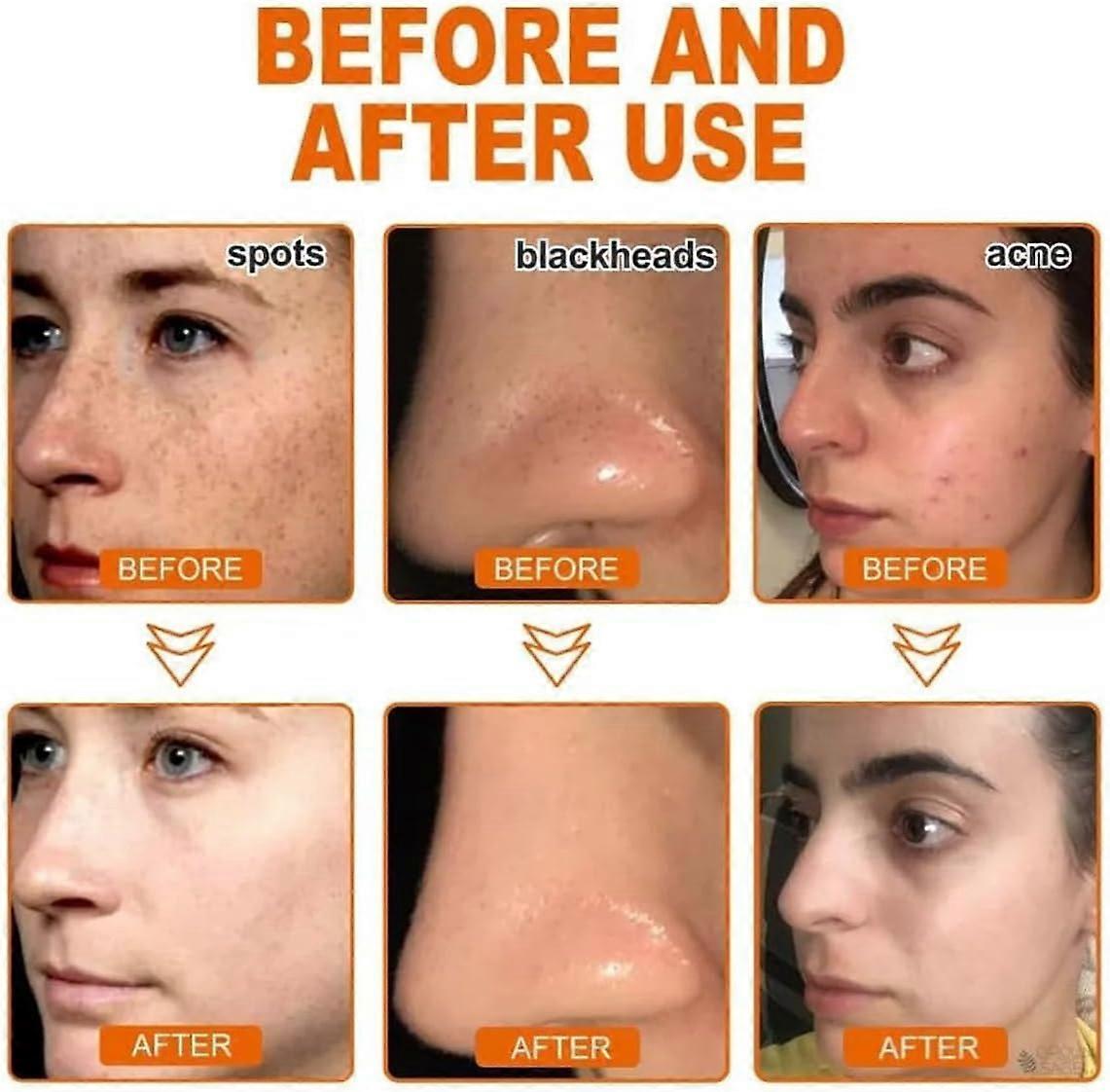 Whitening and Freckle - Removing Mask