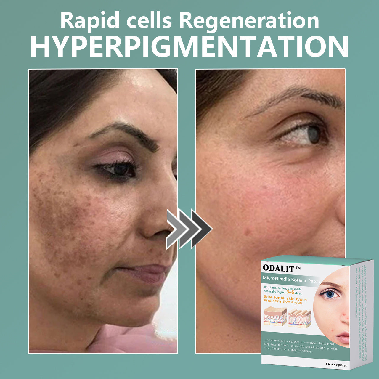 ✨ODALIT™ MicroNeedle Botanic skin Tag Removal Patch Made in the USA