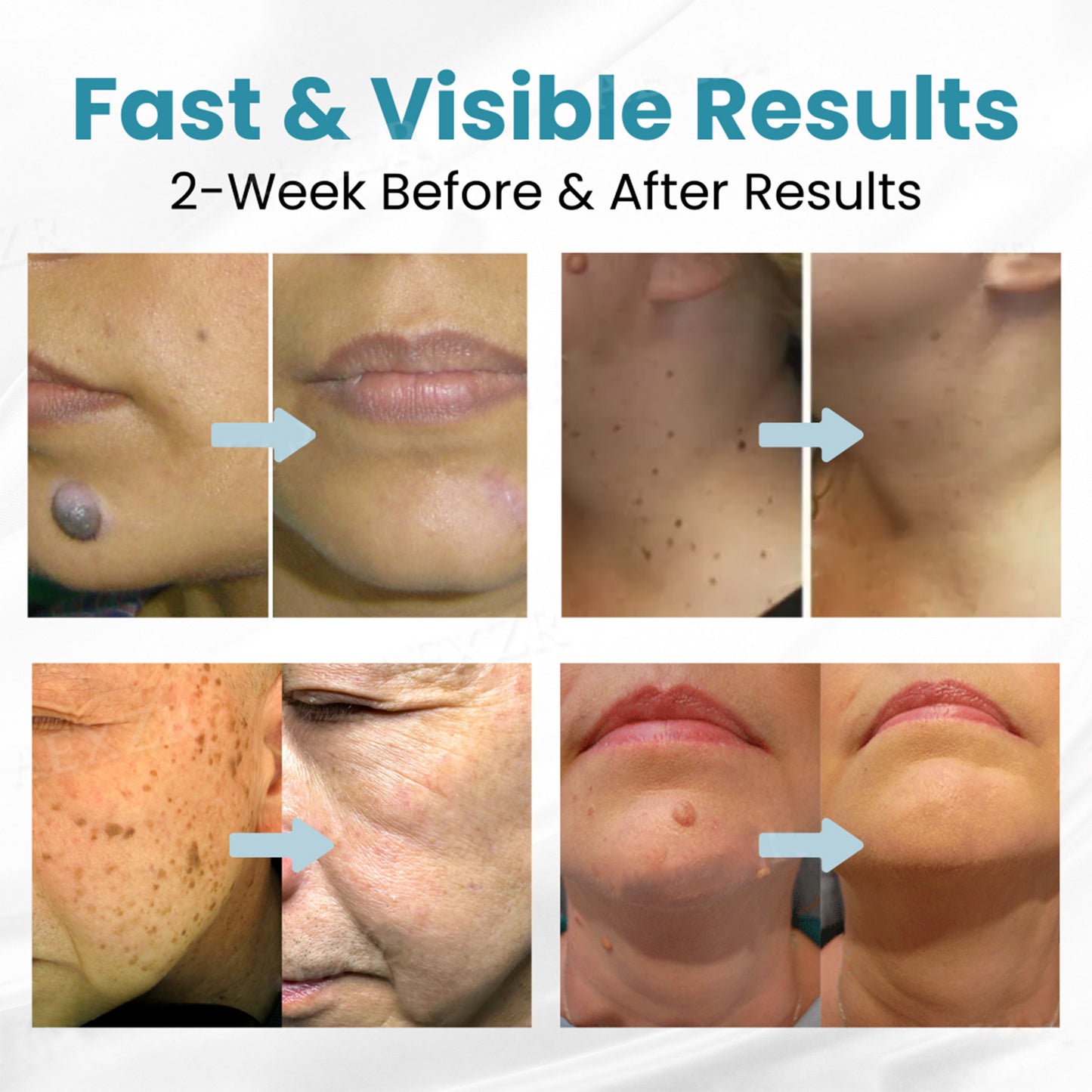 š„ćOFFICIAL STOREćODEIUN⢠Non-Invasive Mole and Wart Removal Laser Pen