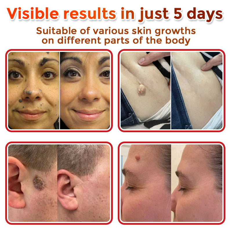 🌈MicroNeedle Botanic Skin Tag Removal Patch|Made in the USA