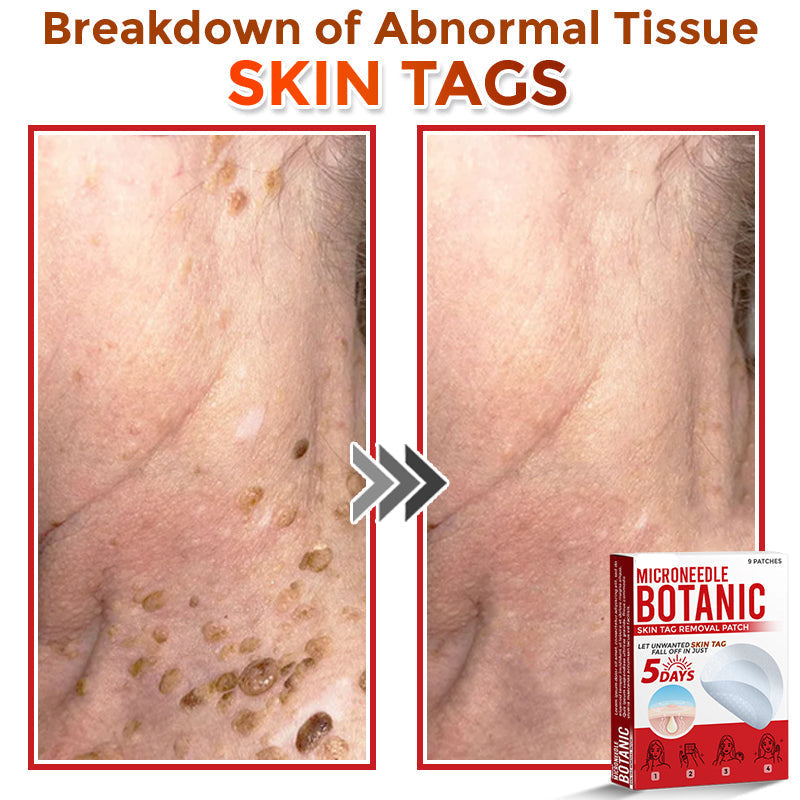 🌈MicroNeedle Botanic Skin Tag Removal Patch|Made in the USA