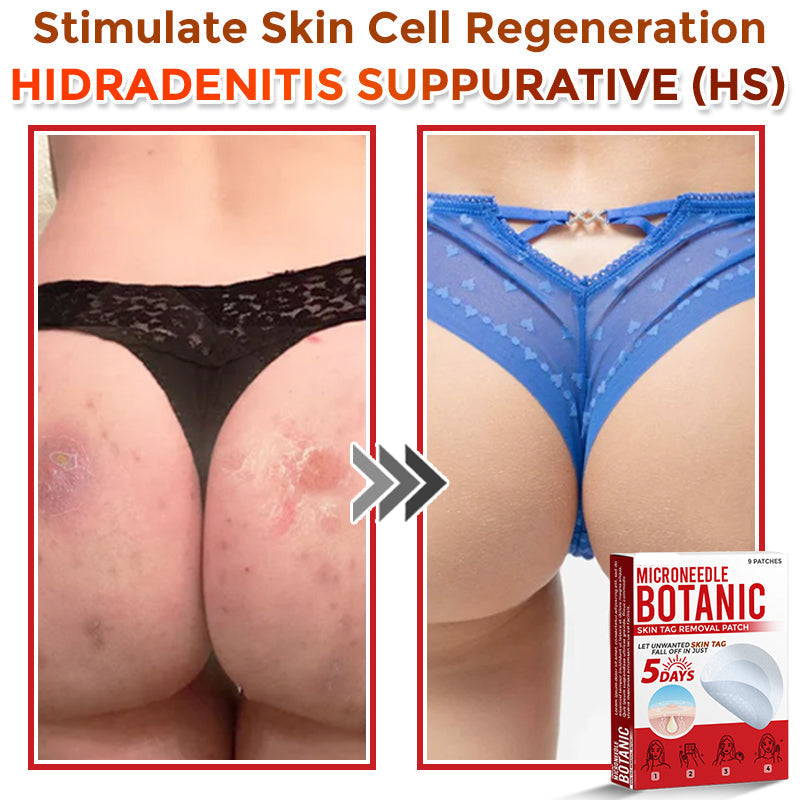 🌈MicroNeedle Botanic Skin Tag Removal Patch|Made in the USA