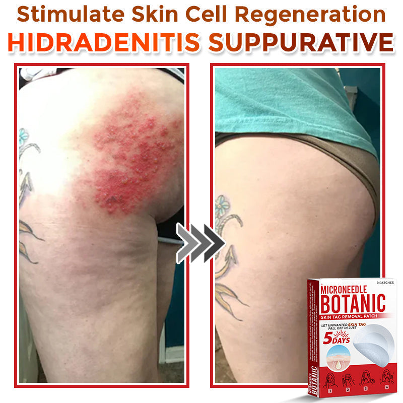 🌈MicroNeedle Botanic Skin Tag Removal Patch|Made in the USA