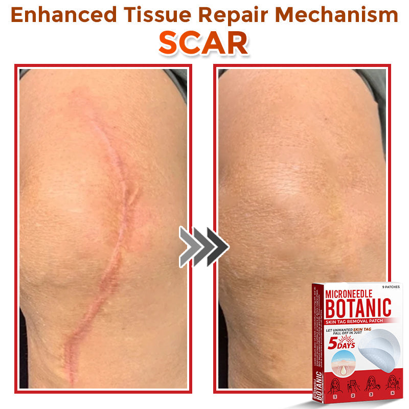 🌈MicroNeedle Botanic Skin Tag Removal Patch|Made in the USA