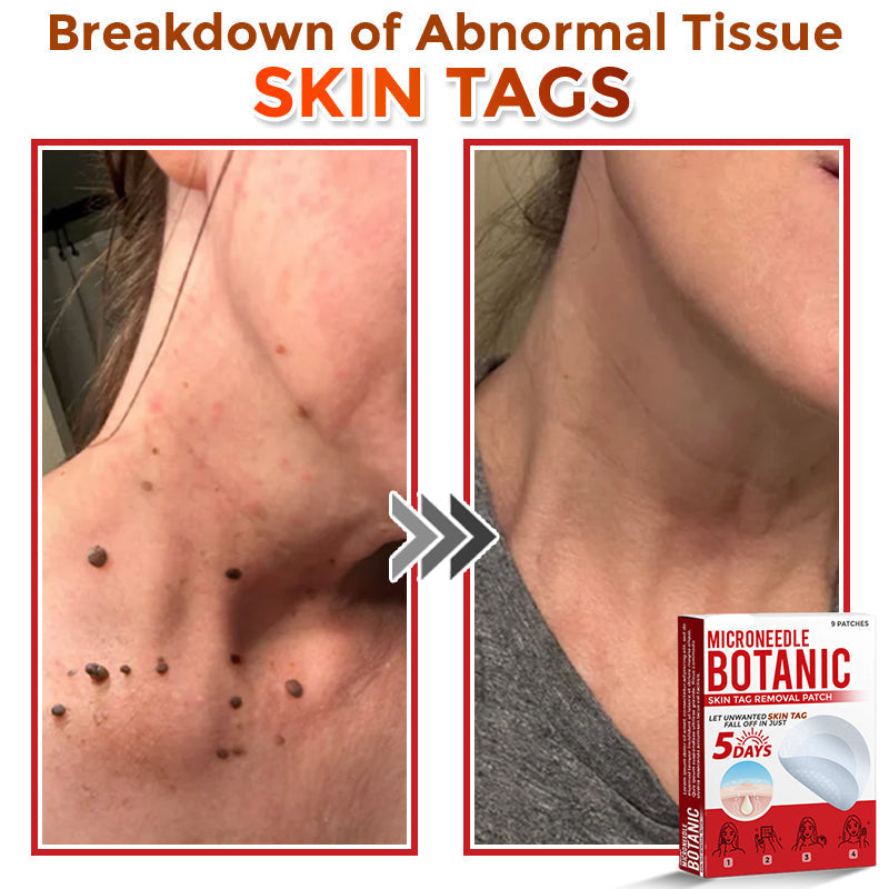 🌈MicroNeedle Botanic Skin Tag Removal Patch|Made in the USA