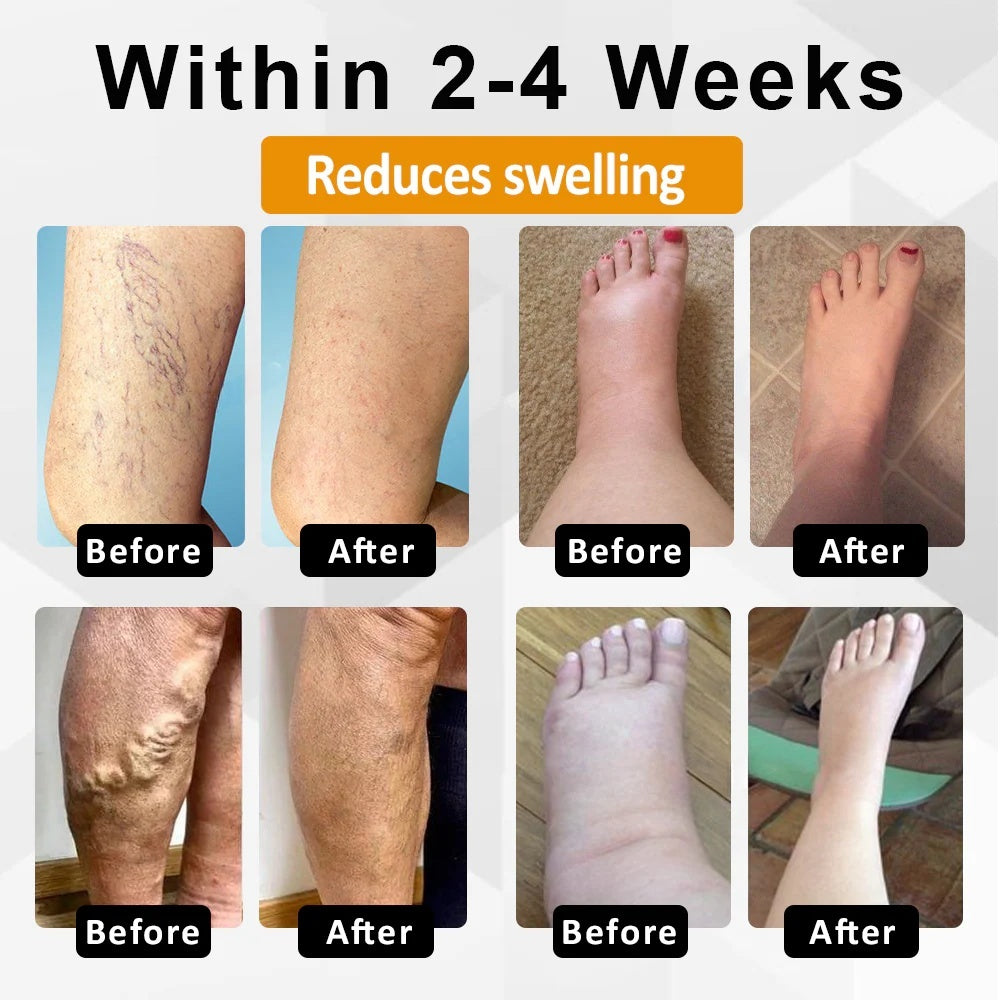 ODALIT® Bromelain Edema & Vein Care Cream