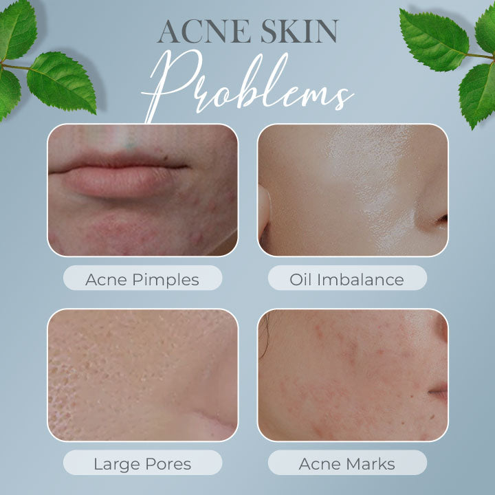 Tea Tree Anti-Acne Cream