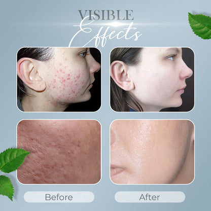 Tea Tree Anti-Acne Cream
