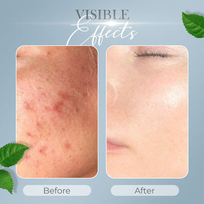 Tea Tree Anti-Acne Cream