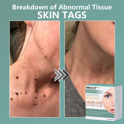 ✨ODALIT™ MicroNeedle Botanic skin Tag Removal Patch Made in the USA