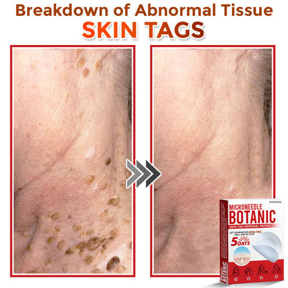 🌈MicroNeedle Botanic Skin Tag Removal Patch|Made in the USA