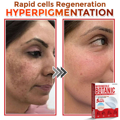 🌈MicroNeedle Botanic Skin Tag Removal Patch|Made in the USA