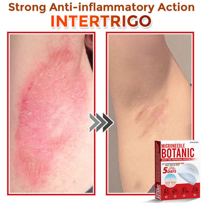 🌈MicroNeedle Botanic Skin Tag Removal Patch|Made in the USA