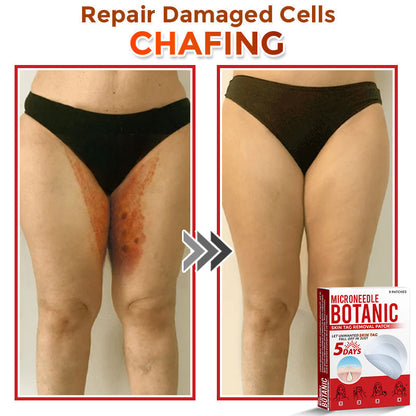🌈MicroNeedle Botanic Skin Tag Removal Patch|Made in the USA