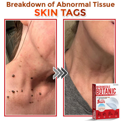 🌈MicroNeedle Botanic Skin Tag Removal Patch|Made in the USA