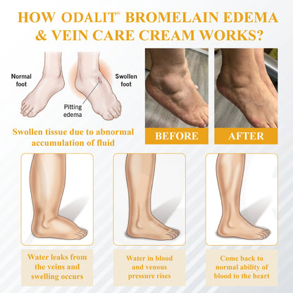 ODALIT® Bromelain Edema & Vein Care Cream